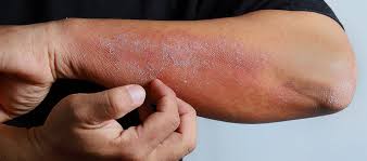 Colloidal oatmeal, ceramides